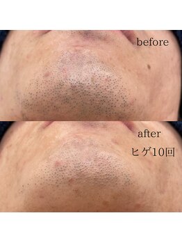 シャレールオム(Chareir Homme)/ヒゲ脱毛10回のビフォーアフター