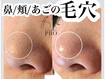 ルアナ(Luana)/【毛穴エクストラクション】