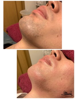 ビューティスペースグリッター(beauty space Glitter)/メンズ髭脱毛