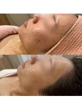 ジャストミービューティー(Just Me Beauty)/ニキビケア