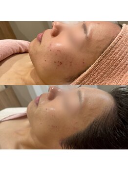 ジャストミービューティー(Just Me Beauty)/ニキビケア