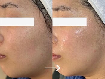 ロイ 初生店(LOI)/60分で小顔に！！小顔リフト