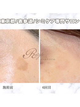アールスタイル 表参道(R-style)/シミケアでコンシーラー要らず♪