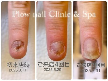 プラウネイル(Plow Nail)