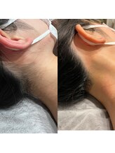 エイチビューティーラボ(h Beauty labo)/うなじ脱毛