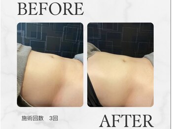 モンド(Mondo)/レモンボトル