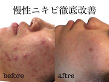 Olu【オル】肌質改善サロン. ハーブピーリング/クリスティーナ/ハーブリプロ