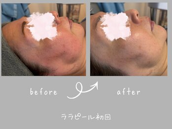 サロン リノ(salon rino)/直後でも結果が見えるララピール