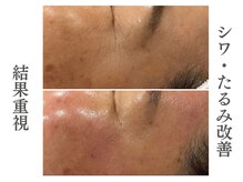 リアム(LiAm)の雰囲気（スーパージェクション/レモンボトル/毛穴ケア/小顔）