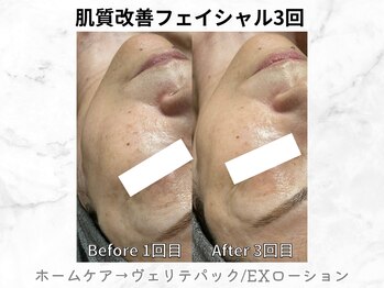リライン(ReLine)/【リアボーテフェイシャル3回】