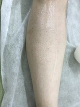 ナノハナ/鹿沼市本格全身脱毛ナノハナ