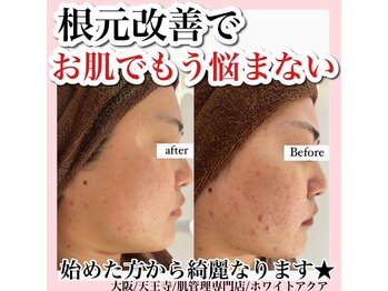 ホワイトアクア 天王寺本店(WHITE AQUA)/ハーブピーリング/大阪/天王寺