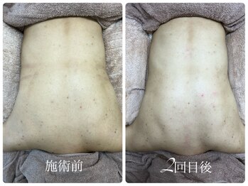 シェミー(CHEZ MEE)/【美ボディ】背中ニキビケア