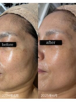 スプレミア(spuremia)/シミ症例