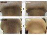 《メンズ脱毛》抜け落ち◎ヒゲ脱毛（パック付き）初回特別価格￥500
