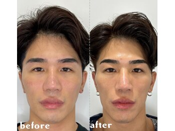 イロハ(IROHA)の写真/《美容男子/お肌をキレイにしたい男性はIROHAへ》毛開き・黒ずみ/凹凸肌/ニキビにお悩みの方に◎
