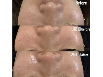 サロン ド ミューナ(salon de Myu-na)の写真/【山科初上陸】韓国に行かなくても叶う最新肌管理！ソフトダーマで憧れの陶器肌へ導きます◎