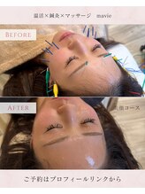 マヴィ(mavie)/美顔コースbefore→after