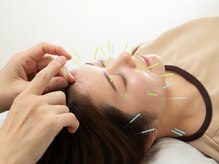 たまプラ治療院/フェイスライン小顔に美容鍼