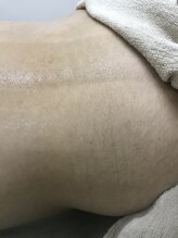 ナノハナ/鹿沼市本格全身脱毛ナノハナ