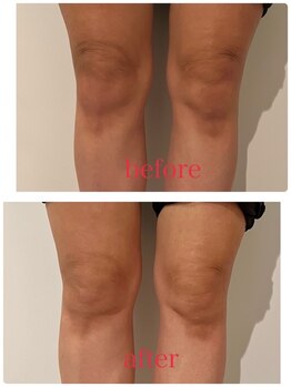 ウナ デ リンゴル 恵比寿店(UNA de Ringol)/膝上のお肉にも【ボディ痩せ】