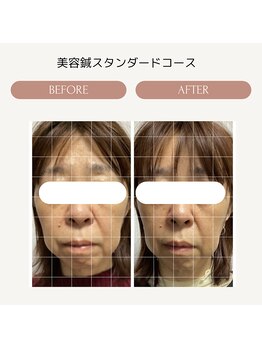 サロン ド ハリッシュ(Salon de HARISH)/お肌の潤いプラス