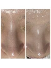 毛穴塾/鼻毛穴洗浄＋最新美容ララピール