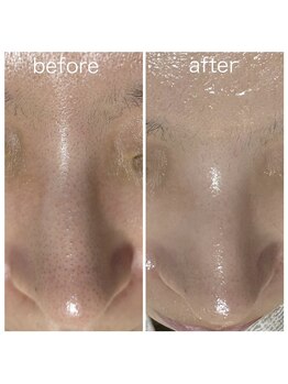 毛穴塾/鼻毛穴洗浄＋最新美容ララピール