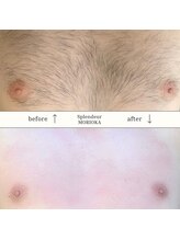 スプランドゥール(Splendeur)/メンズ　胸　ワックス＋光脱毛