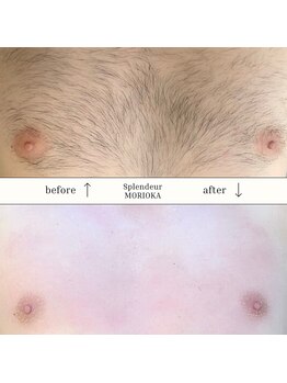 スプランドゥール(Splendeur)/メンズ 胸 ワックス+光脱毛