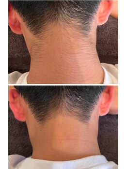 シンデレラ メンズ(Cinderella)/うなじ脱毛