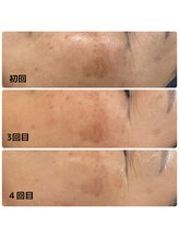 ミアローザ(Mia Rosa)/光フェイシャルでシミ改善