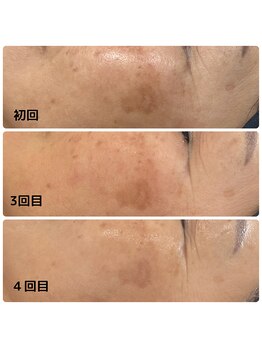 ミアローザ(Mia Rosa)/光フェイシャルでシミ改善