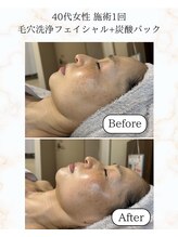 シーフェイス 横浜店(SEE FACE)/毛穴洗浄フェイシャル炭酸パック