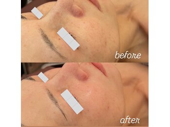 リノ(Lino)/陶肌トリートメントbefore after