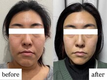 マカオン(machaon)/【小顔リフト】小顔マッサージ