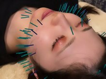 アロエベル(aloe Belle)/美容鍼