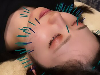 アロエベル(aloe Belle)/美容鍼