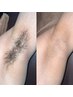【男女可能〇最新機器★痛みが少ない★都度払い】両脇脱毛¥3,000