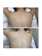 39 beauty salon.横浜関内【WAX脱毛/メンズ眉毛/水素吸入しながら】/背中Wax