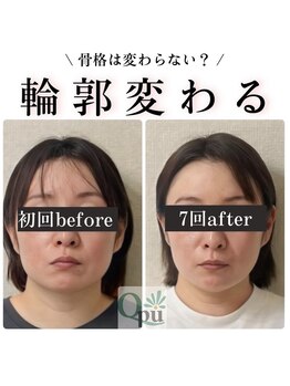 キュープ 松戸店(Qpu)の写真/憧れの小顔へ◎歪みの原因にアプローチ！人生で一番小さな顔にあなたも出会える☆