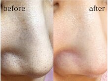 ジェリー(JERRY)/小鼻の黒ずみ