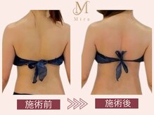 ミラ 札幌店(Mira)/【痩身】ハイパーナイフ