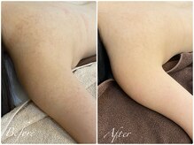 滑らかなお背中に★【ハーブピーリング・毛穴・横浜・ニキビケア