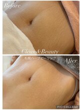 クリーンアンドビューティ 札幌(Clean&Beauty)/妊娠線/肉割れ/むくみ、お肉！