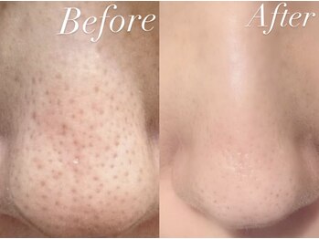 ラ ルアナ(La Luana)/毛穴洗浄×菌ケア