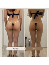 プラチナアース 守谷店(Platinum earth)/痩身ビフォーアフター