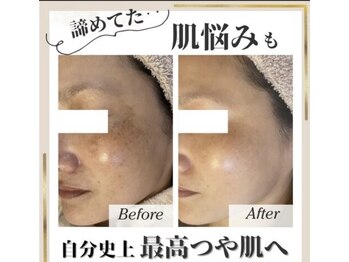 エスポワール(espoir)/光フォト症例