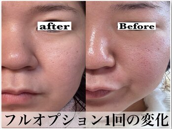 ビジュープラス 広島店(Bijou+)/【30代/凹凸肌】