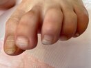 自爪ケア前;肥厚爪,2枚爪の事例
